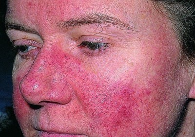 10 dấu hiệu sớm của bệnh lupus ban đỏ. Xem ngay!